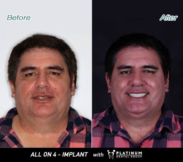 Final Step: Placement of Permanent Porcelain Teeth
