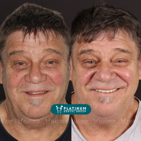 All-on-4 dental Implants offer significant advantages for full-mouth restoration