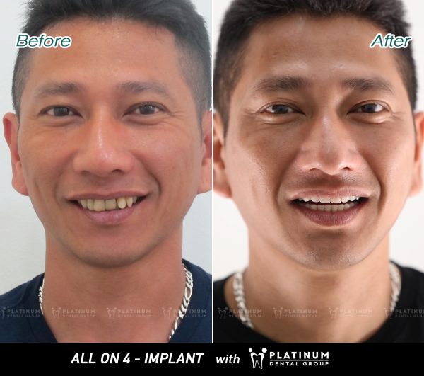 All on 4-Implant is for someone with significant bone loss who wants to avoid grafting