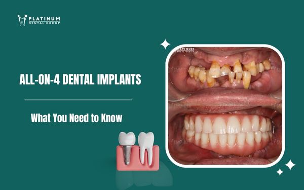 all-on-4-dental-implants
