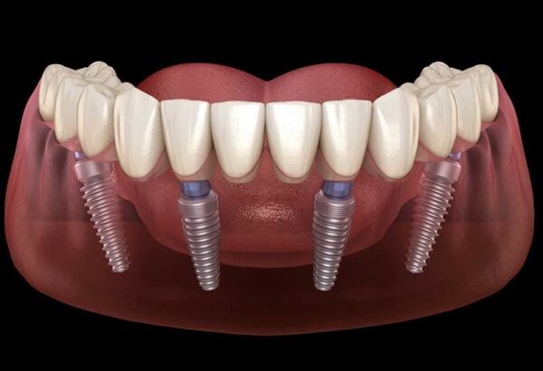 All-on-4 approach relies on just four strategically placed Implants