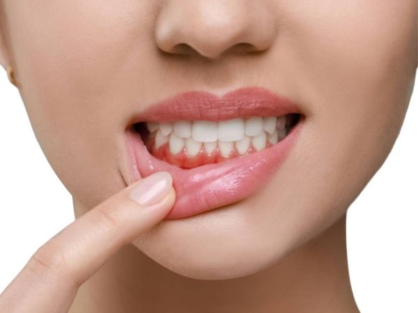 Gọi tên các biến chứng sau khi bọc răng sứ thường gặp và cách phòng tránh 2 Viêm tủy răng khiến người bệnh thường cảm thấy đau nhức dữ dội
