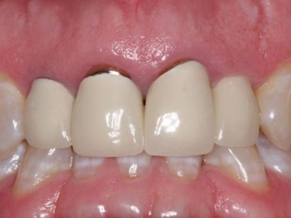 Gọi tên các biến chứng sau khi bọc răng sứ thường gặp và cách phòng tránh 3 Hở cổ chân răng là tình trạng phần mão sứ không ôm sát vào răng thật, để lộ khe hở tại viền nướu
