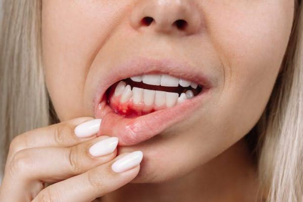Bleeding gums are an early warning sign of gum irritation or disease. Timely care helps prevent progression from gingivitis to periodontitis.