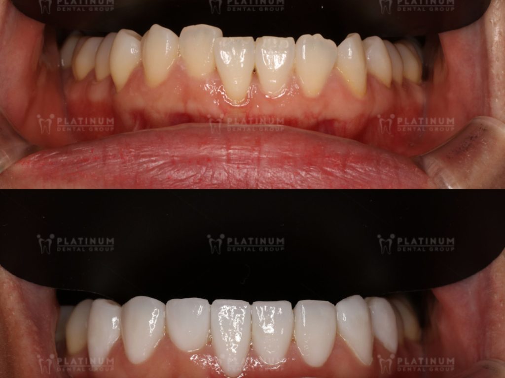 Tuổi thọ của răng sứ cũng phụ thuộc rất nhiều vào tình trạng răng miệng ban đầu