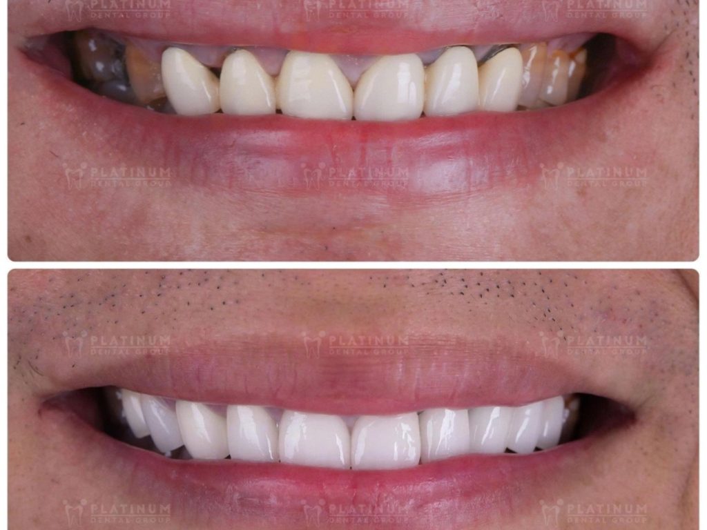 Mão sứ không còn khít sát với răng và nướu tạo điều kiện vi khuẩn tích tụ