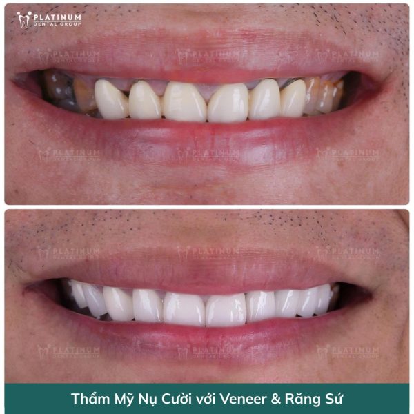 Giải đáp: Bọc răng sứ bao lâu thì phải làm lại? 6 Mão sứ không còn khít sát với răng và nướu tạo điều kiện vi khuẩn tích tụ