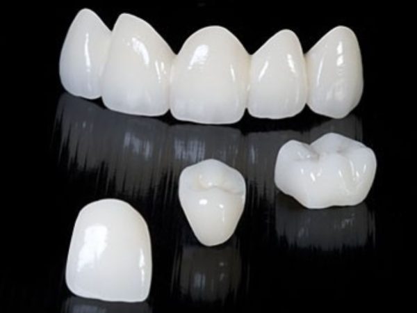 Giải đáp từ nha khoa: Bọc răng sứ có bền không? 2 Răng toàn sứ có tuổi thọ trung bình từ 15-25 năm, thậm chí có thể lâu hơn nếu chăm sóc đúng cách