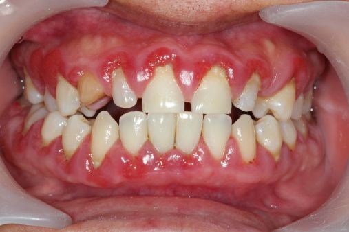 Giải đáp từ nha khoa: Bọc răng sứ có bền không? 4 Tình trạng răng trước bọc cũng là yếu tố ảnh hưởng đến độ bền của răng sứ
