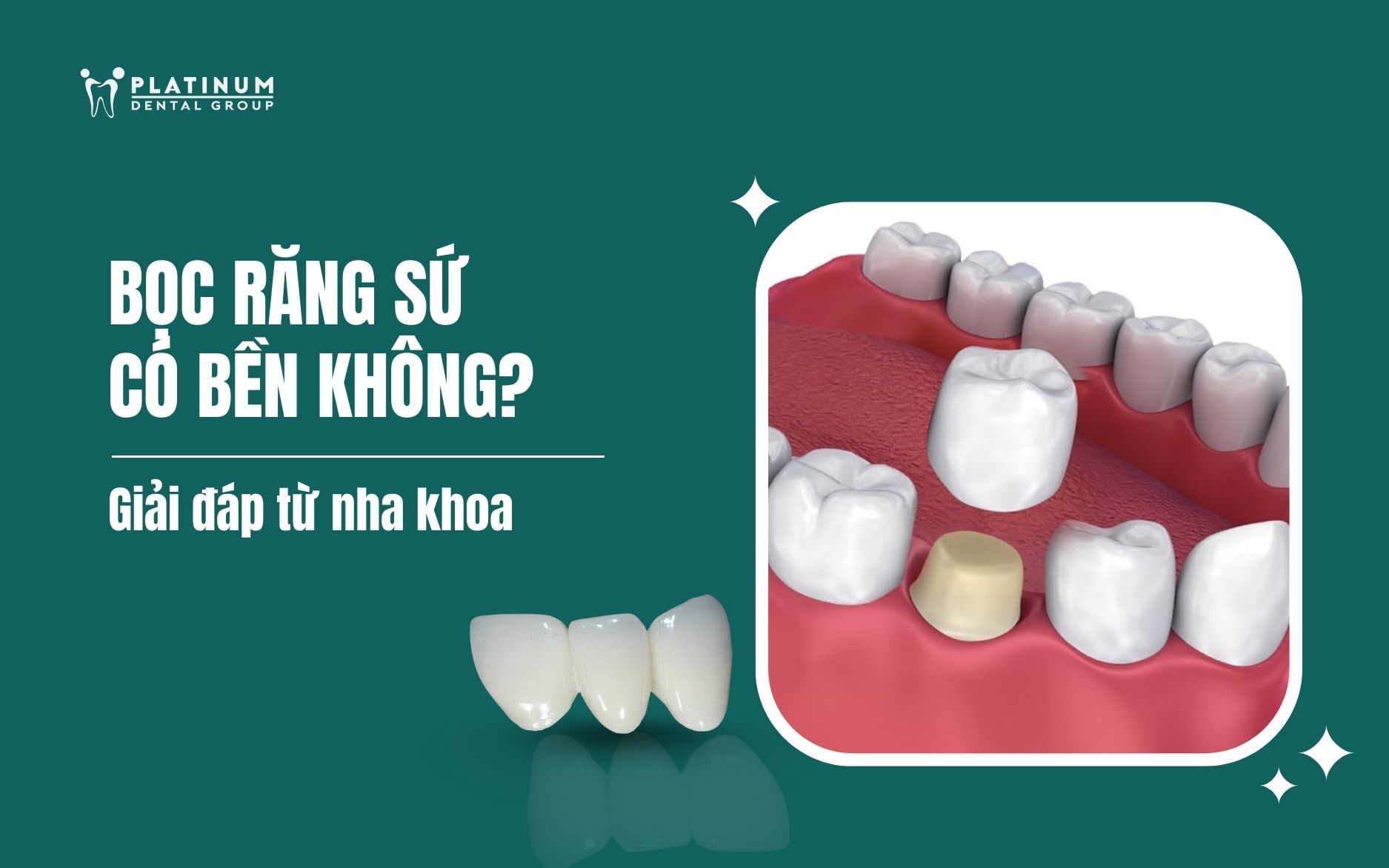bọc răng sứ có bền không