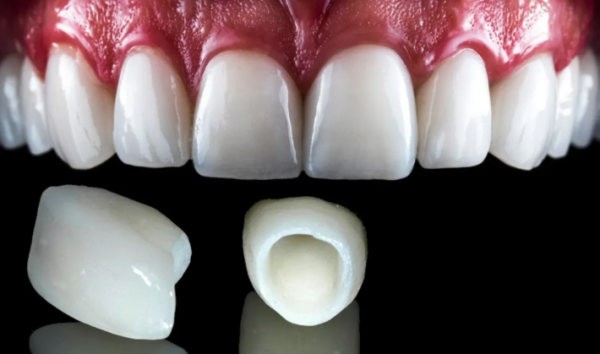 Ceramic Crown Vs Porcelain Crown: Which One Should You Choose? 1 Ceramic crown vs porcelain crown refer to the same category of materials