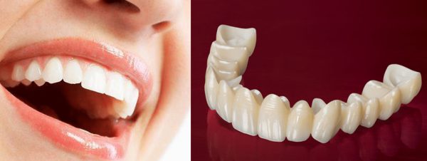 Ceramic Crown Vs Porcelain Crown: Which One Should You Choose? 2 Big pros of ceramic crown vs porcelain crown