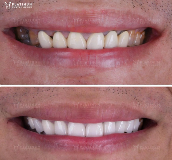 Ceramic Crown Vs Porcelain Crown: Which One Should You Choose? 4 The cost of ceramic crown vs porcelain crown