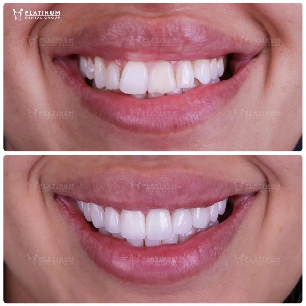 Our patient’s transformation with porcelain Veneers shows how natural, luminous, and long-lasting results can be
