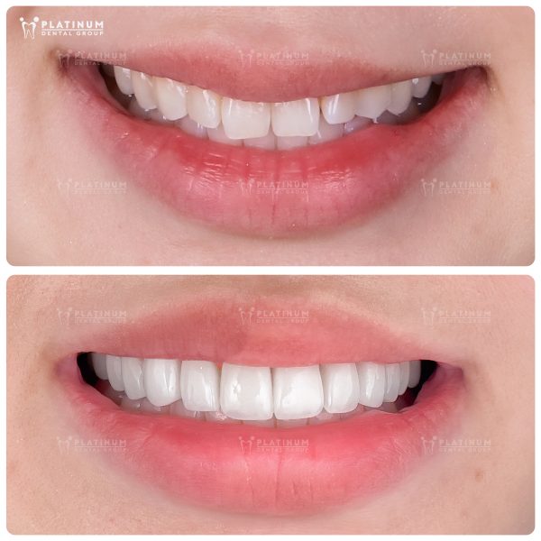 Before & after: a naturally beautiful smile with premium ceramic veneers