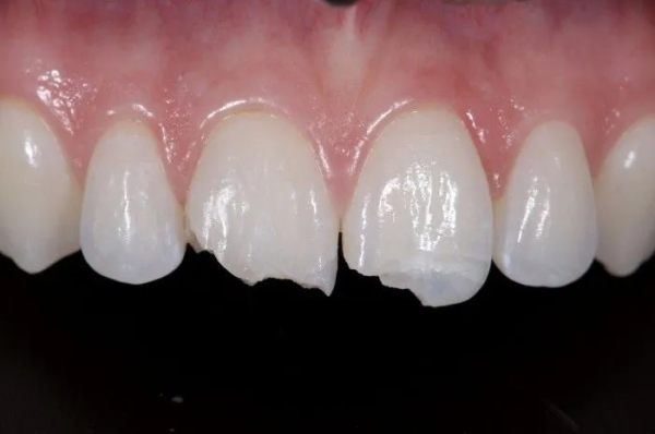 Common signs of a cracked or chipped tooth — from visible damage to increased sensitivity and discomfort when chewing