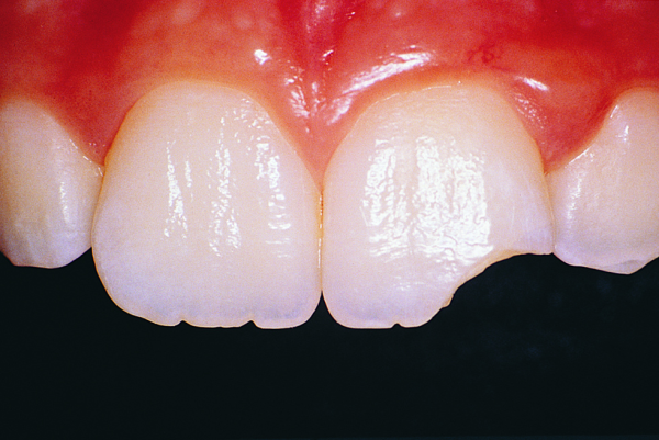 A close-up view of a chipped front tooth, highlighting the visible damage to the enamel