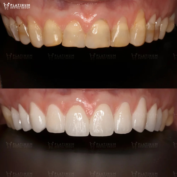 Răng bị xỉn màu, ố vàng nặng hoặc nhiễm kháng sinh thì nên làm răng sứ