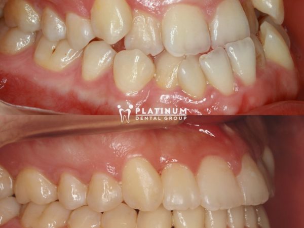 Giải đáp: Có nên làm răng sứ không? 3 Trường hợp sai lệch khớp cắn nghiêm trọng, hô móm nên chọn giải pháp niềng răng