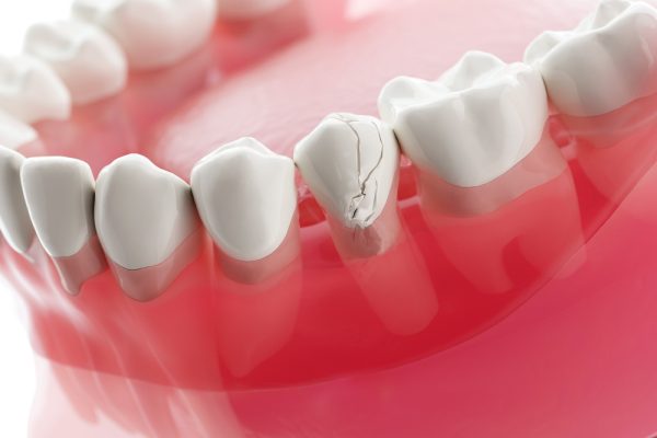 Cracks in teeth can be hard to spot — Platinum Dental Group uses advanced imaging to detect and treat them early