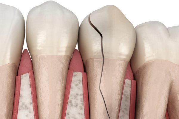 Symptoms of a cracked tooth can include sharp chewing pain, temperature sensitivity, intermittent discomfort, and rough edges — early detection is key