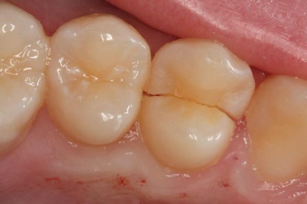 Age, previous dental work, and weakened enamel from poor oral hygiene can increase the risk of cracked teeth