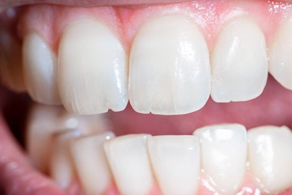 Simple steps to protect a cracked tooth and ease discomfort before your dental visit