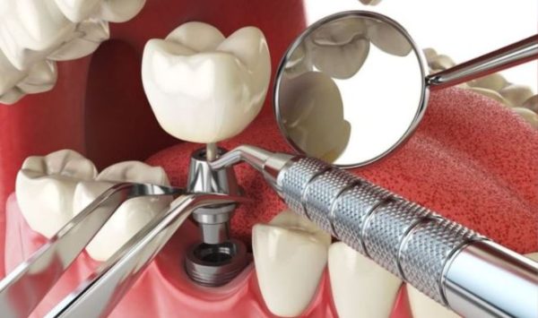The porcelain crown is attached once the Implant post has fully integrated with the jawbone
