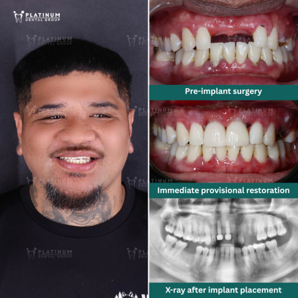 Reputable and High-Quality Front Tooth Restoration at Platinum Dental Group