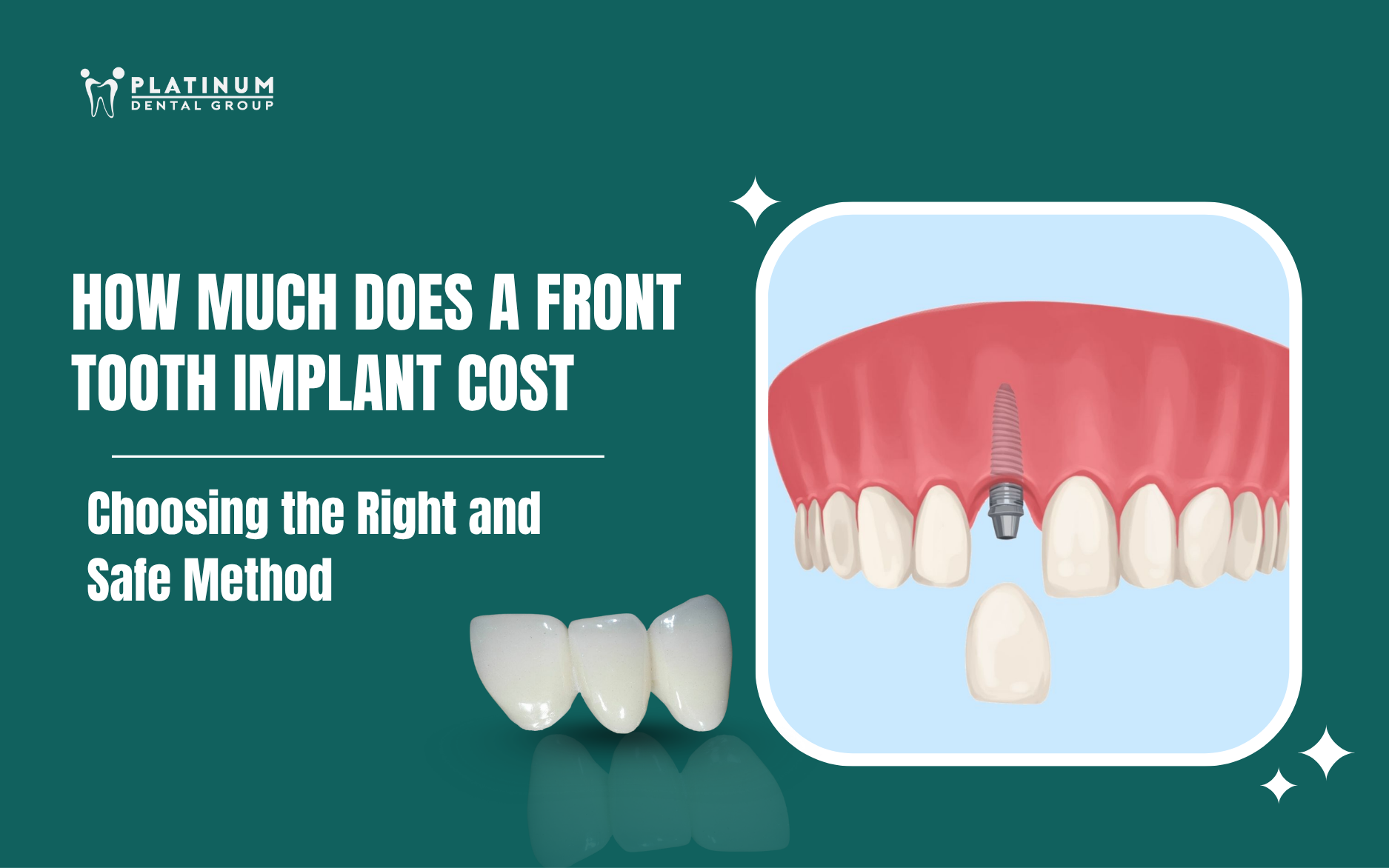 front tooth implant