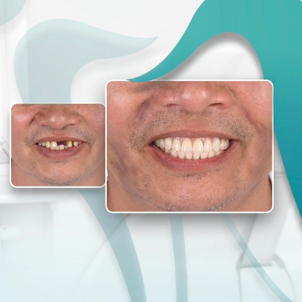 Mr. T, who had previously lost his front tooth, regained a complete smile and confidence in communication after receiving a Dental Implant