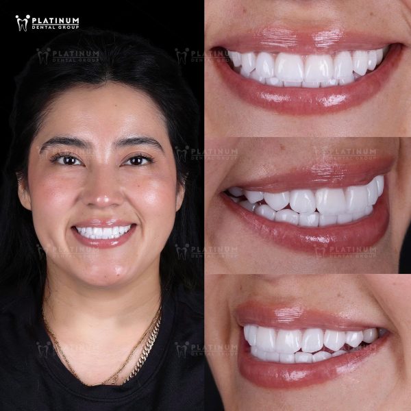 Khám phá giải pháp thẩm mỹ hiện đại, giữ nguyên răng thật và vẫn có nụ cười đẹp tự nhiên
