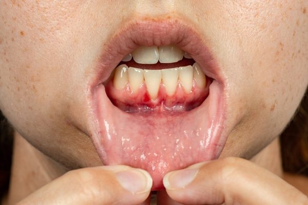 Gum infection: causes, stages, treatment & prevention 1 Gum infection starts as gingivitis - an early, reversible stage affecting only the soft gum tissue