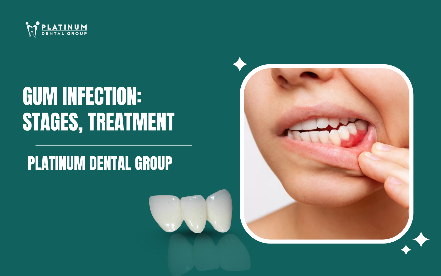 Gum infection treatment at Platinum Dental Group