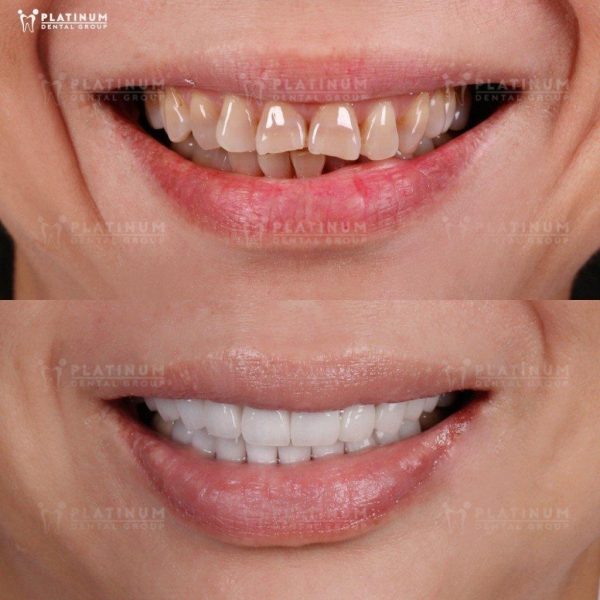 You should choose a reputable dental clinic and an experienced doctor to have porcelain crowns