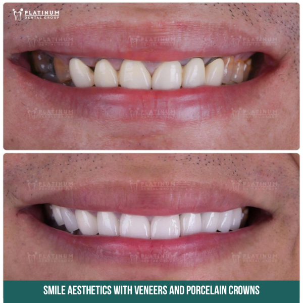 The porcelain crown no longer fits tightly with the tooth and gum, creating conditions for bacteria to accumulate