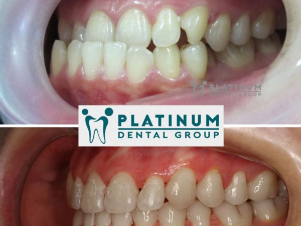 Những trường hợp không nên bọc răng sứ - Cẩn trọng trước khi làm 1 Với trường hợp lệch nặng (cắn chéo, cắn sâu, cắn hở, hô, móm), việc bọc sứ hoàn toàn không hiệu quả thay vào đó khách hàng nên chọn giải pháp chỉnh nha.