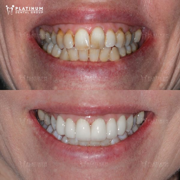 Một ca bọc răng sứ cho bệnh nhân răng bị xỉn màu, ố vàng nặng, khó tẩy trắng được thực hiện tại Platinum Dental Group