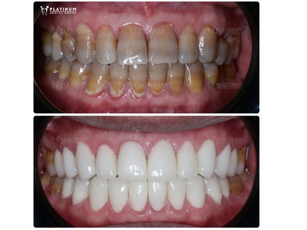 Những trường hợp không nên bọc răng sứ - Cẩn trọng trước khi làm 4 Một ca bọc răng sứ cho bệnh nhân răng bị xỉn màu, ố vàng nặng, khó tẩy trắng được thực hiện tại Platinum Dental Group