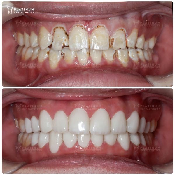 Các ca bọc răng sứ tại Platinum Demtal được thực hiện đúng kỹ thuật, hạn chế tối đa tình trạng răng sẽ bị tổn thương, gây ê buốt khi ăn nhai