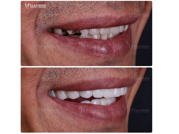 Những trường hợp không nên bọc răng sứ - Cẩn trọng trước khi làm 5 Mão sứ bao phủ toàn bộ thân răng, răng thật bên trong được bảo vệ tốt hơn