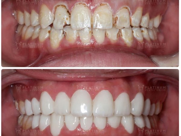 Những trường hợp không nên bọc răng sứ - Cẩn trọng trước khi làm 6 Các ca bọc răng sứ tại Platinum Demtal được thực hiện đúng kỹ thuật, hạn chế tối đa tình trạng răng sẽ bị tổn thương, gây ê buốt khi ăn nhai