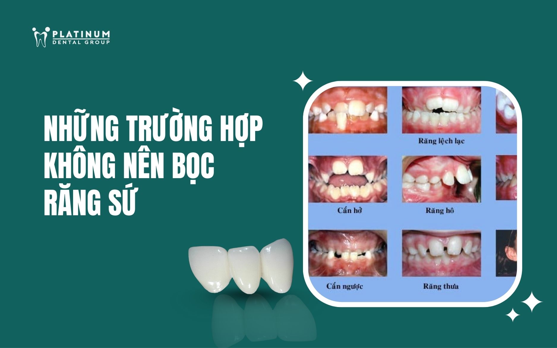 những trường hợp không nên bọc răng sứ