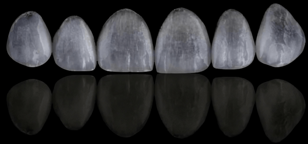 Main pros and cons of no prep Veneers