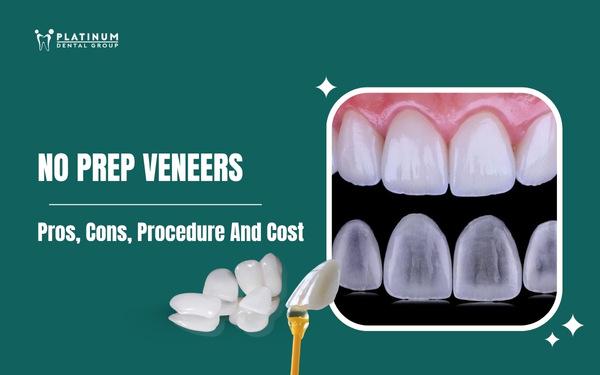 no prep veneers
