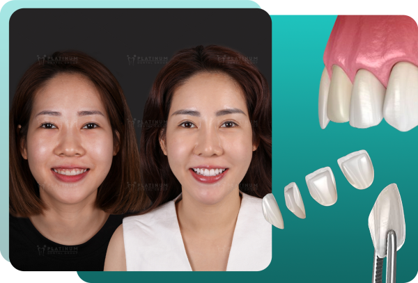 No prep Veneers are a conservative cosmetic dental treatment