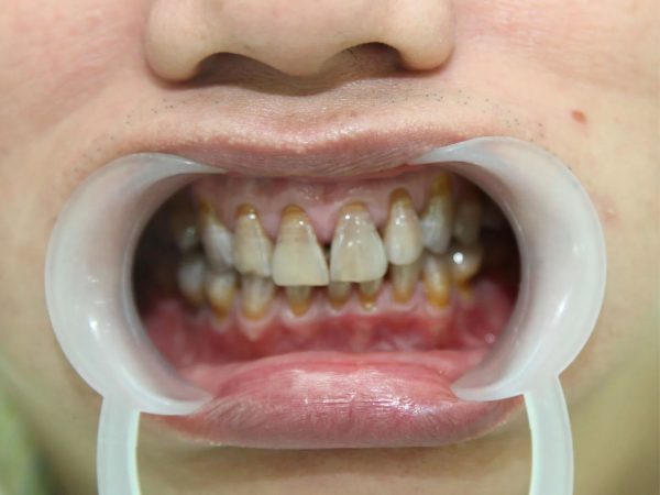 Định nghĩa răng nhiễm Tetracycline là gì?
