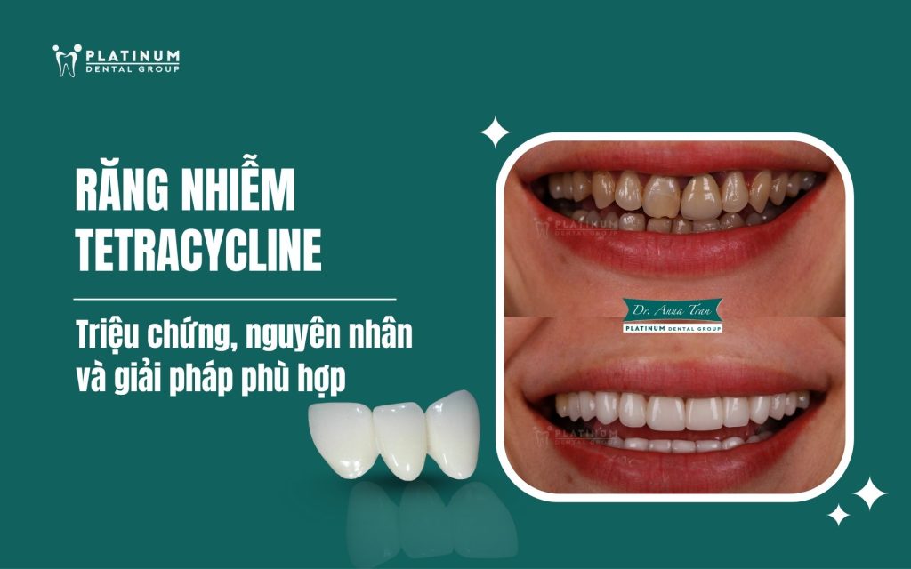 răng nhiễm tetracycline