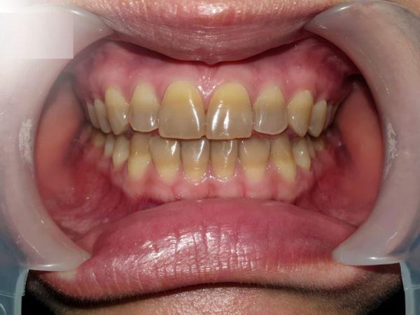 Triệu chứng nhận biết răng bị nhiễm Tetracycline