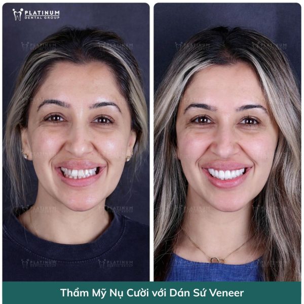 Dán sứ Veneer có thể khắc phục tình trạng răng bị nhiễm Tetracycline nhẹ